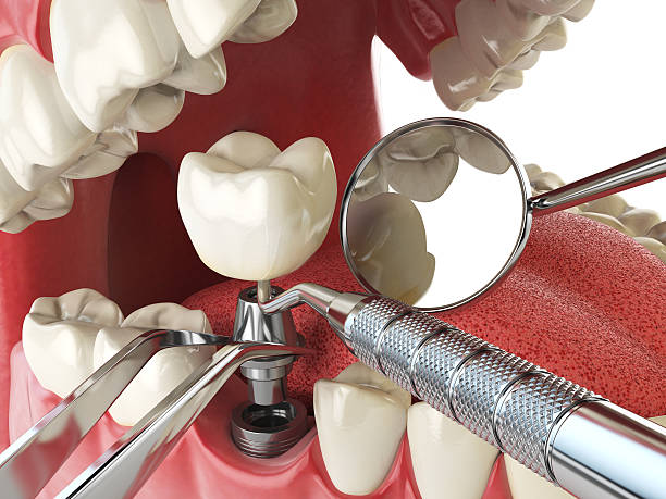 Best Knocked-Out Tooth (Avulsed Tooth) Treatment in Falls City, OR